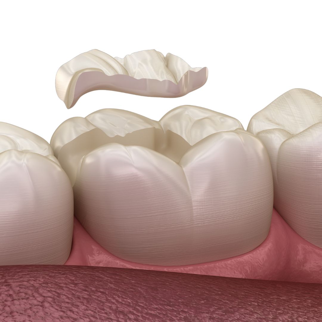 Incrustaciones dentales onlays clinica dental doctoras gandia