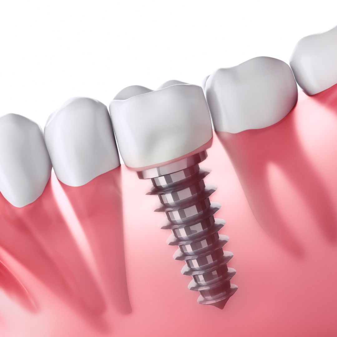 implantes dentales Estética dental doctoras gandia clinica dental