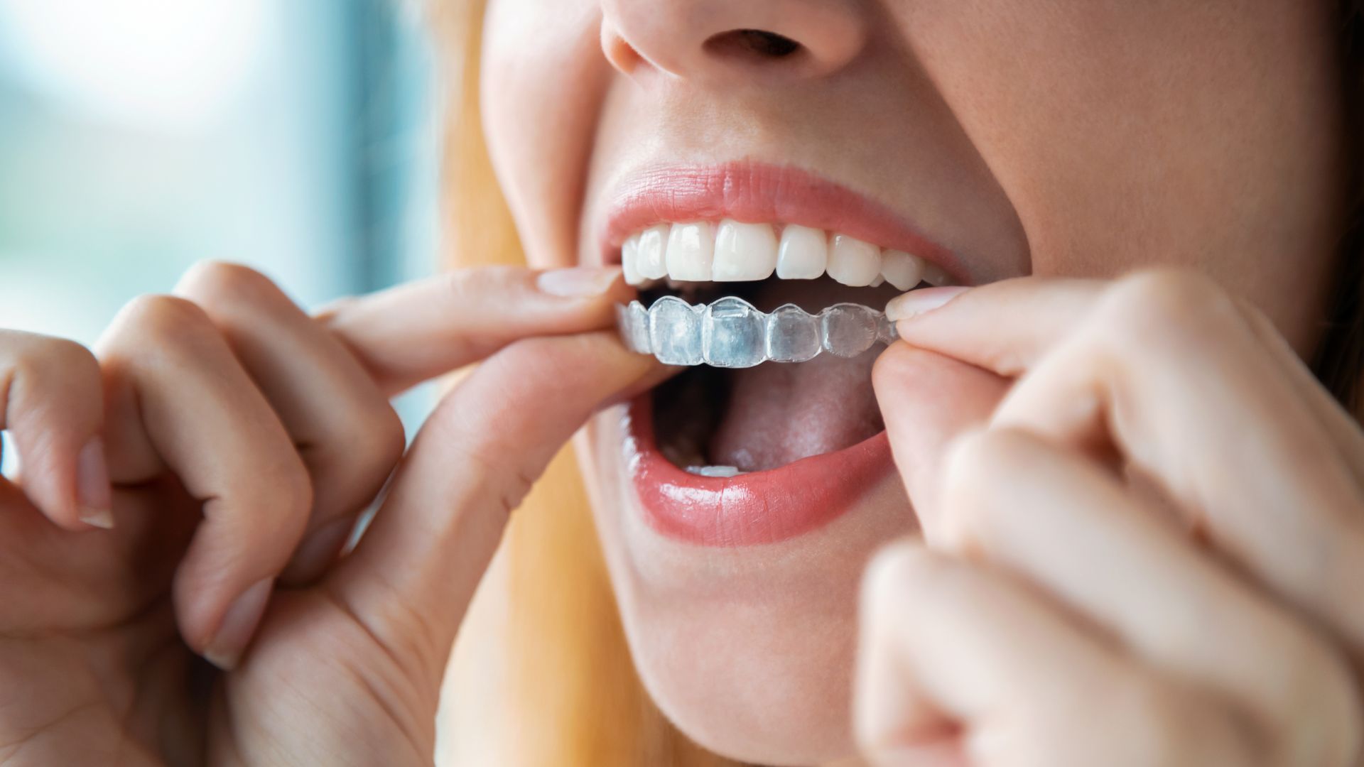 Ortodoncia invisible estetica dental clinica dental doctoras gandia