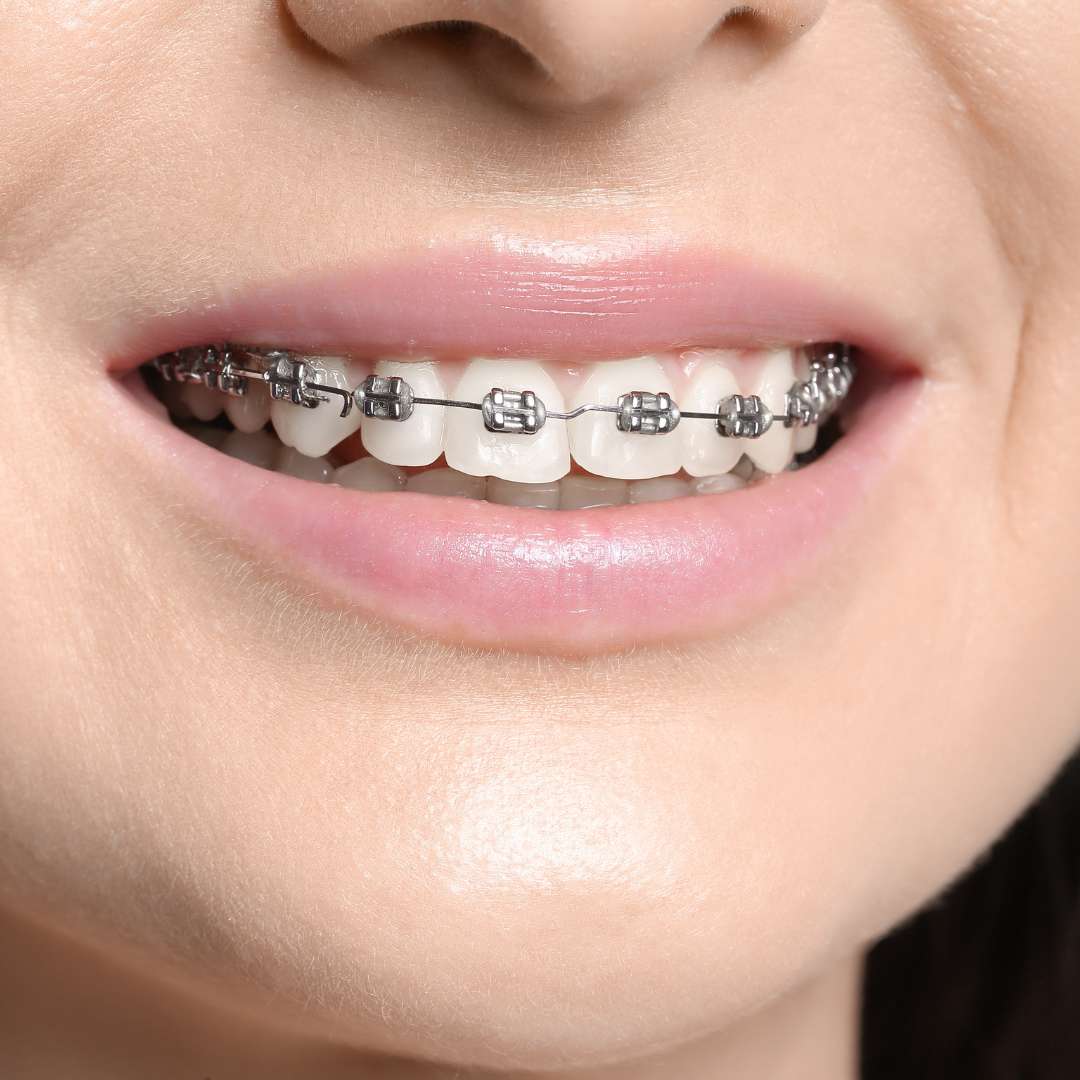 Brackets para niños - clinica doctoras gandia