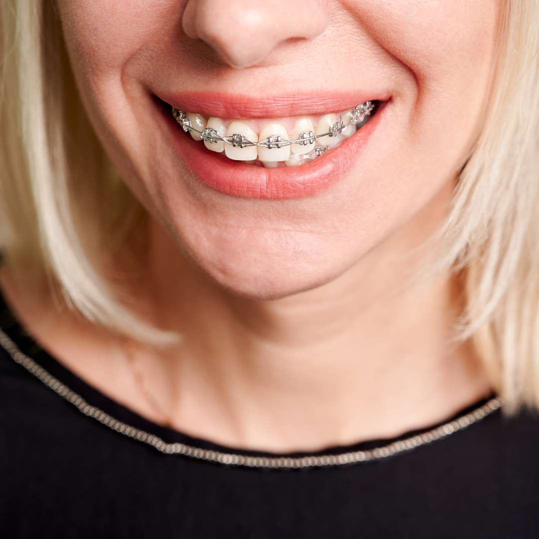 brackets para niños clinica dental doctoras gandia