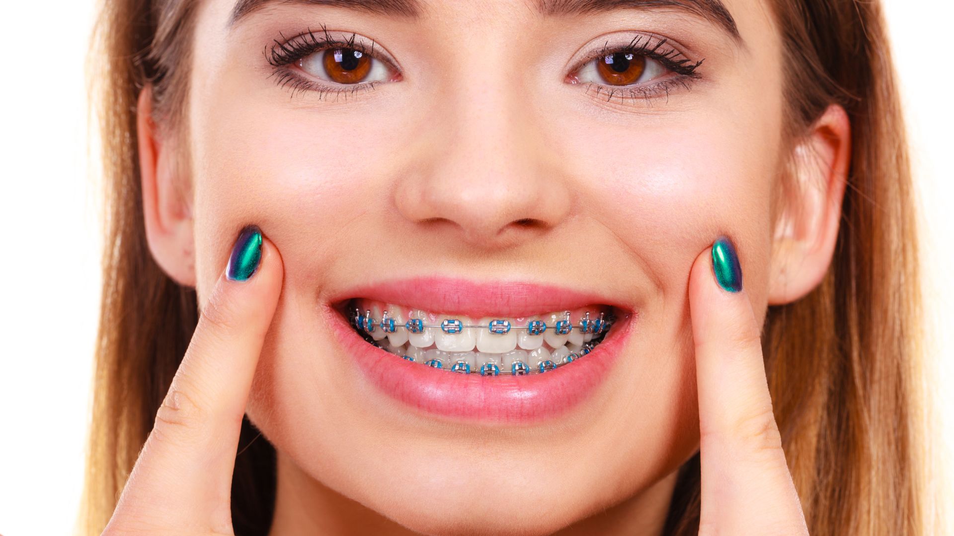 Ortodoncia correctiva. Brackets.